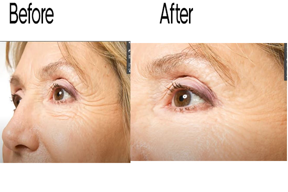 Remove wrinkles Before