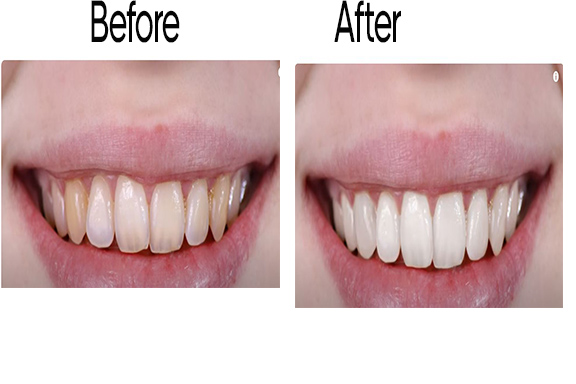 Whiten teeth Before